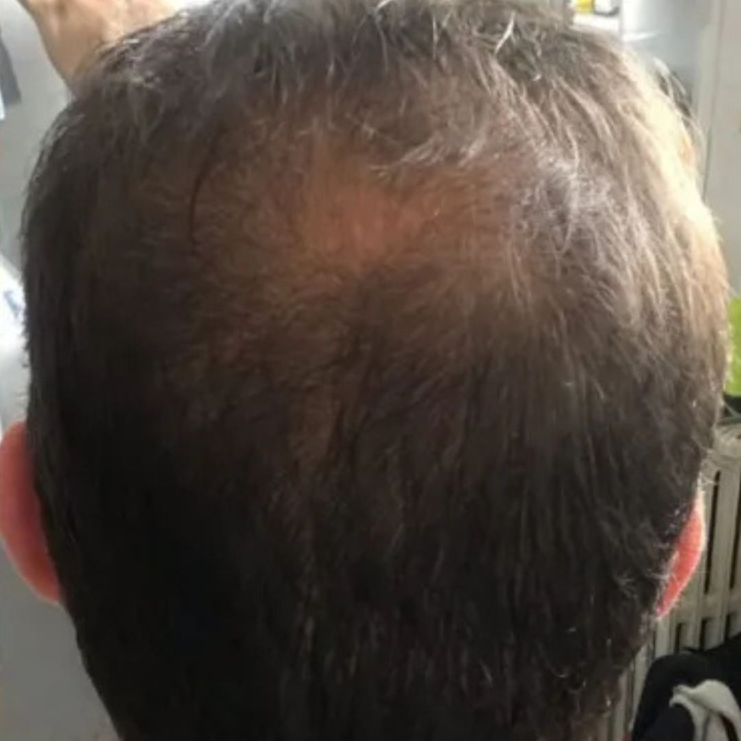 Ricrescita capelli dopo trattamento con cellule staminali vegetali