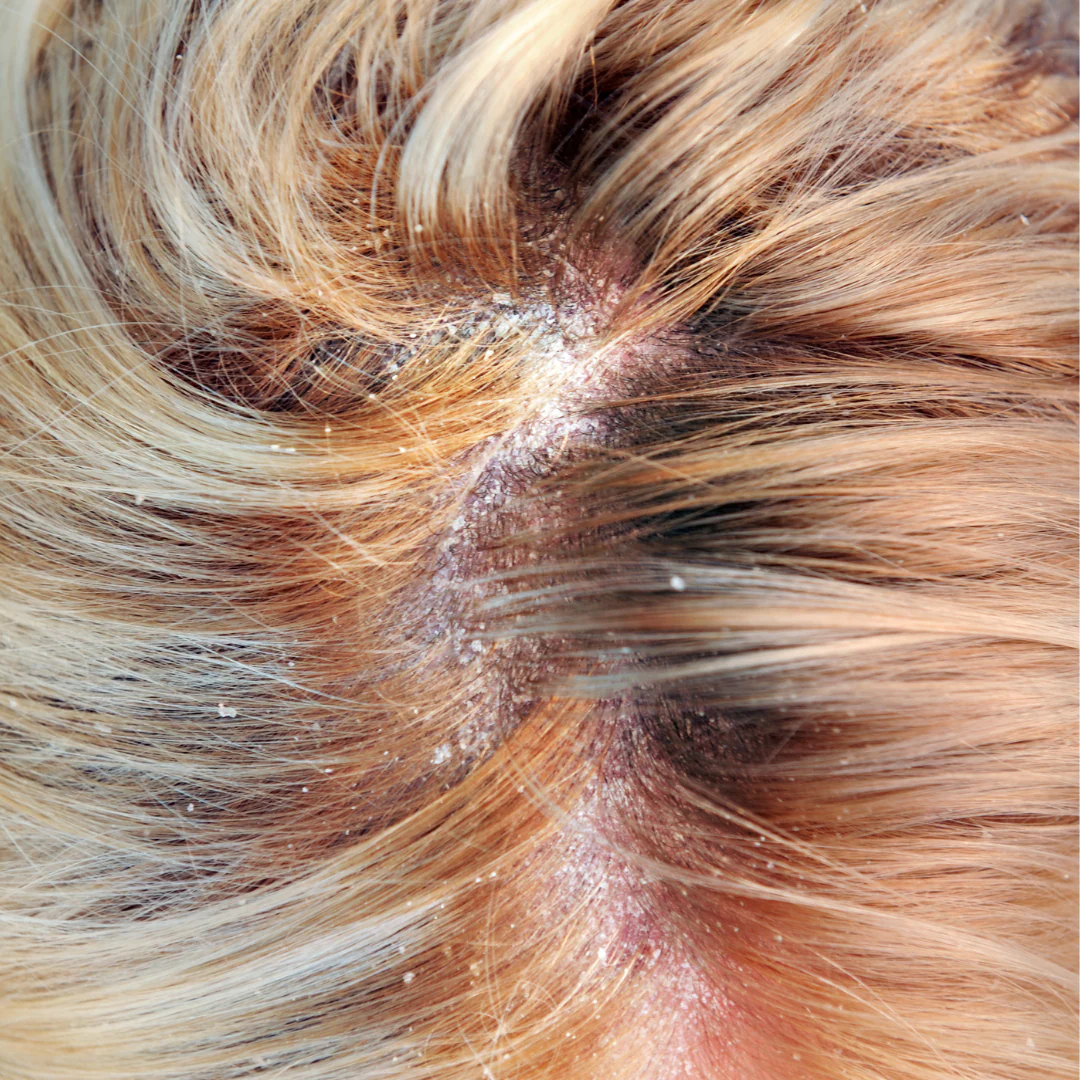 Trattamento Dermatite Seborroica con cellule staminali vegetali